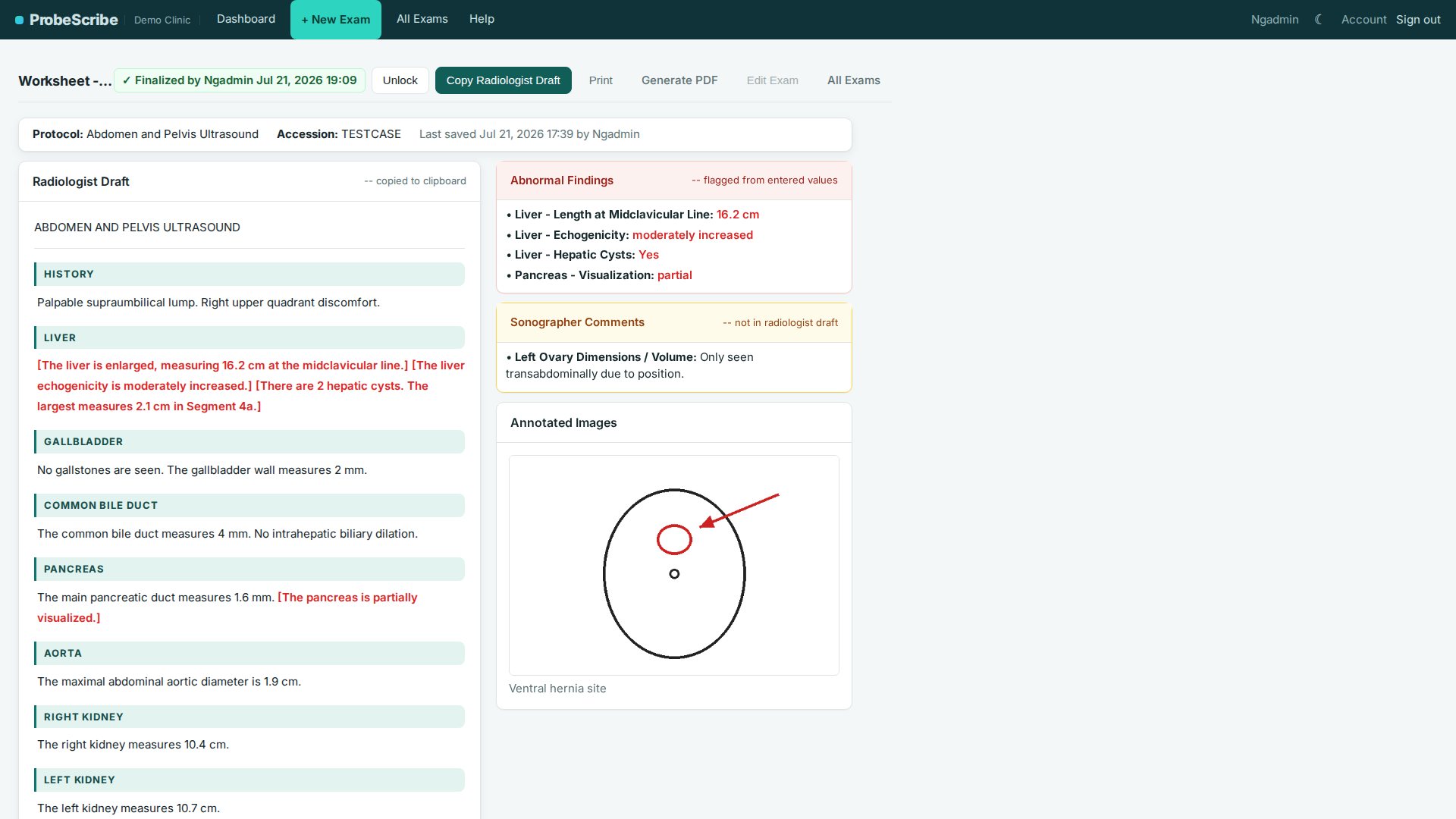 Finalized exam report screen with the generated radiologist draft and Copy Draft and Print buttons